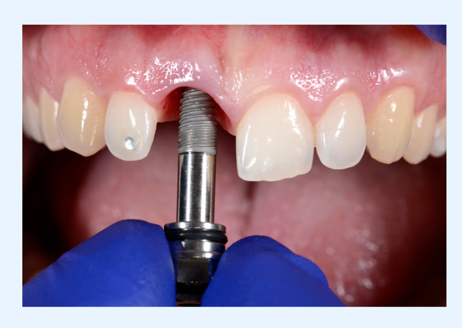 Dental Implants